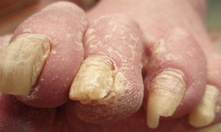 Onychomycosis - Treatment, Pictures, Causes, Symptoms