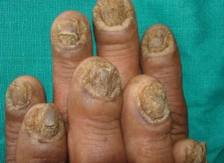 Onychomycosis - Treatment, Pictures, Causes, Symptoms