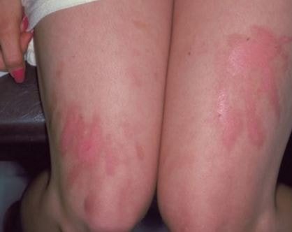 photodermatitis pictures 2