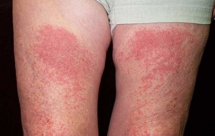 photodermatitis pictures 4