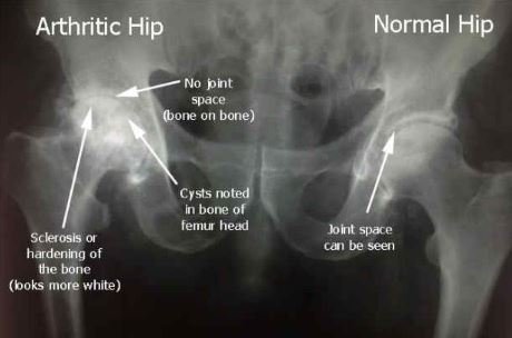 hip osteoarthritis