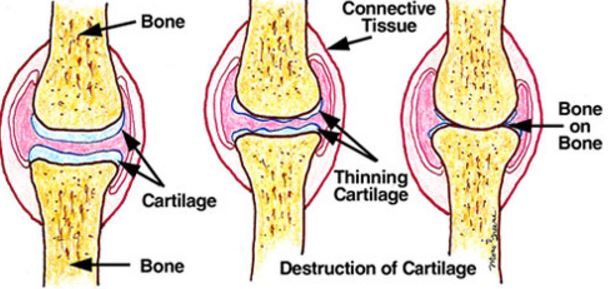 knee-osteoarthrits