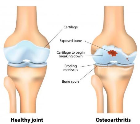 osteoarthritis-image