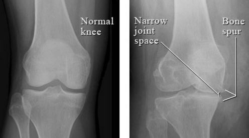 osteoarthritis x ray knee