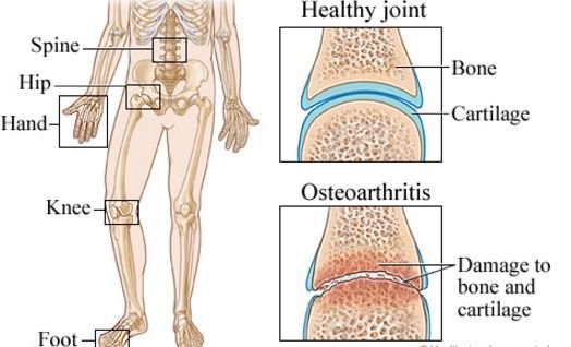 osteoarthritis-pathophysiology-joint-destruction