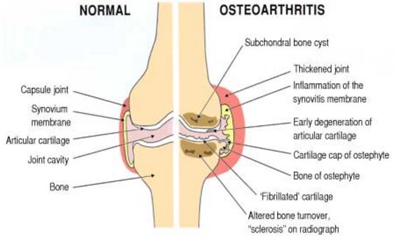osteoarthritis-pic