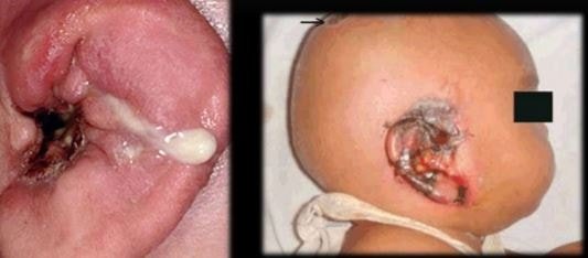 otitis-externa-chronic-malignant-photo-7