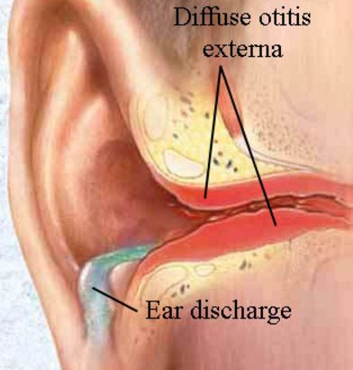 otits-externa-diffuse-pictures-2