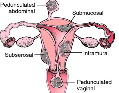 leiomyomas-of-uterus