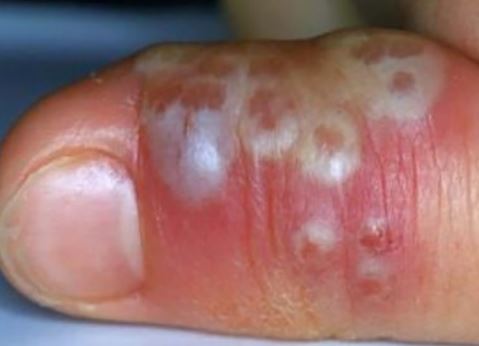 herpetic-whitlow-of-thumb