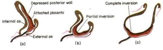 inverted uterus picture