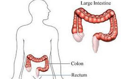 inflamed colon