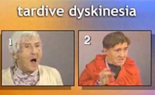 tardive dyskinesia image