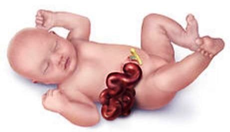 gastroschisis image