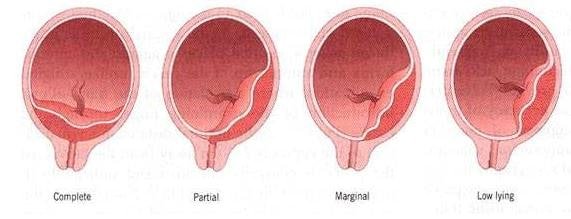 cephalic presentation during low lying placenta