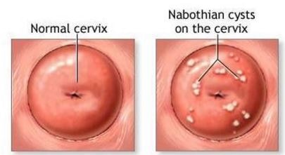 nabothian cyst picture