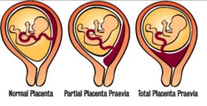 cephalic presentation during low lying placenta