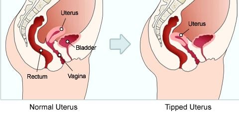 Tipped Uterus - What is?, Symptoms, Causes, Treatment, Dx