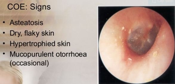 Otitis Externa - Malignant, Treatment, ICD 9, What is, Symptoms, Acute