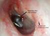 swollen-ear-canal-pictures