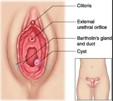 Bartholin gland duct cyst