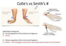 collies vs. smith fracture