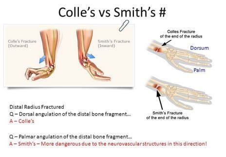 Colles fracture vs Smith