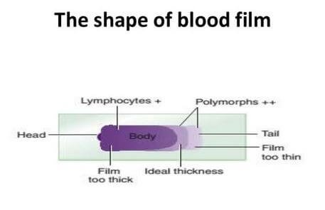 Peripheral Blood Smear