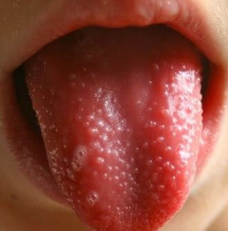 Tongue Warts Images