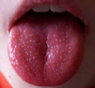 Tongue Warts Pictures HPV