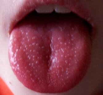 Genital Warts Around The Mouth