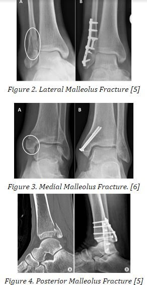 Trimalleolar Fracture medial lateral posterior