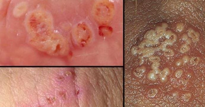 Vaginal Pimples