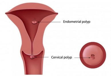 Vaginal Polyps