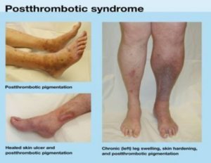 Post Thrombotic Syndrome - Symptoms, Treatment, Causes, Diagnosis