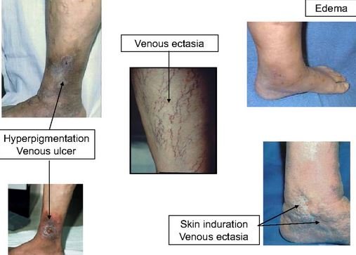 Post Thrombotic Syndrome Symptoms