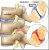 Facet Arthropathy