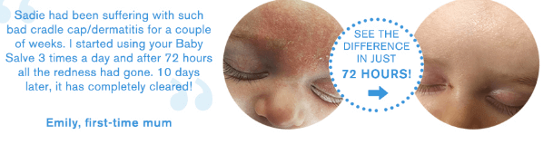 Cradle Cap Treatment