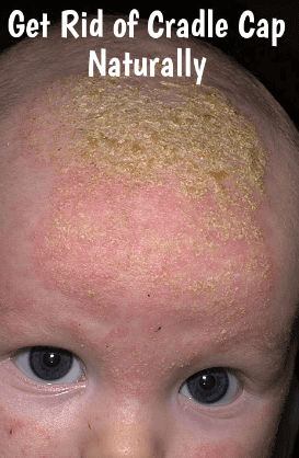 How To Get Rid Of Cradle Crap on scalp