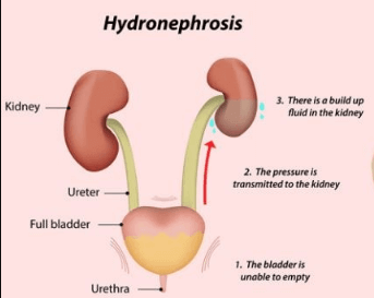 Hydroureteronephrosis of kidney