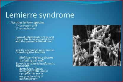 Lemierre Syndrome Treatment