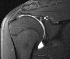 MRI Of Labral Tear (1)