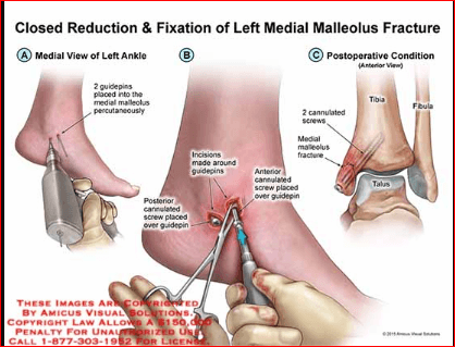 Medial Malleolus Fracture Treatment