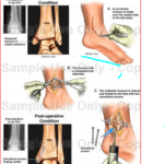 Medial Malleolus Fracture (leg & Feet)