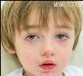 Papular Urticaria in children