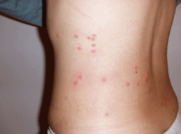 Papular Urticaria picture