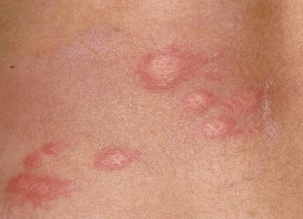 Papular Urticaria symptoms