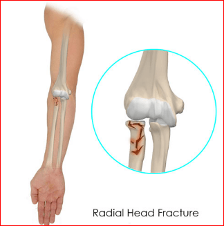 Radial Head Fracture Treatment
