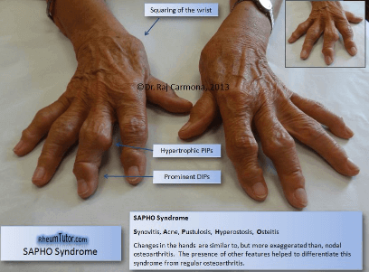 Sapho Syndrome (arms)