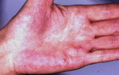 Sapho Syndrome on hand